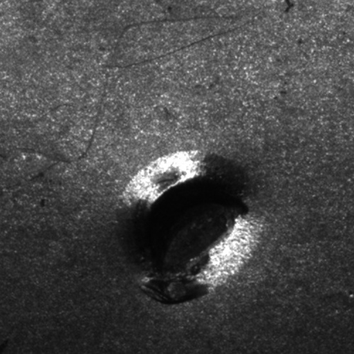 Defeito detectado de uma solda cuja tensão elétrica ultrapassou a capacidade do material rompendo-o.